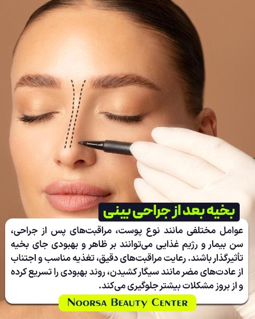 عوامل موثر بر بهبود بخیه بعد از جراحی بینی