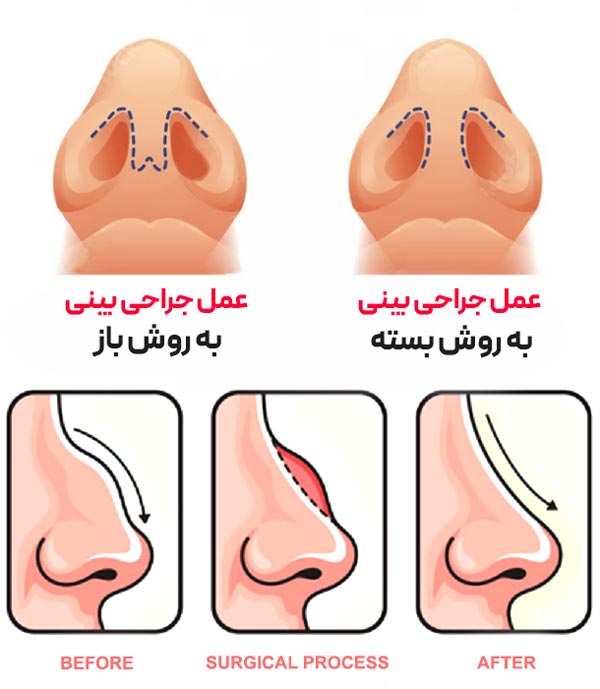 جراحی بینی به روش باز در مقایسه با روش بسته