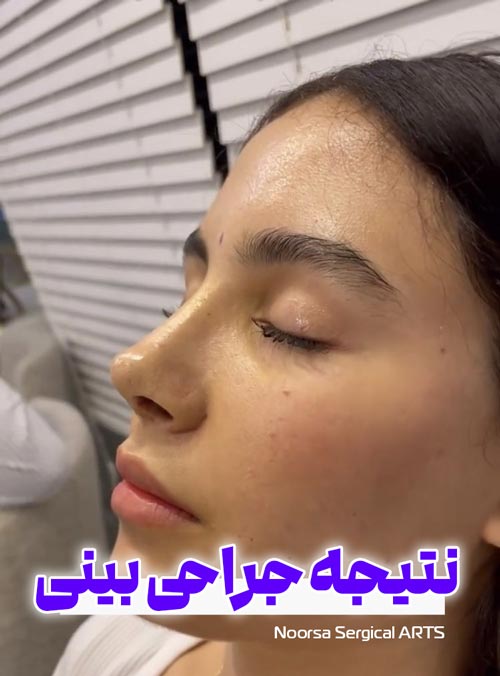 نتیجه نهایی جراحی بینی در کلینیک زیبایی نورسا