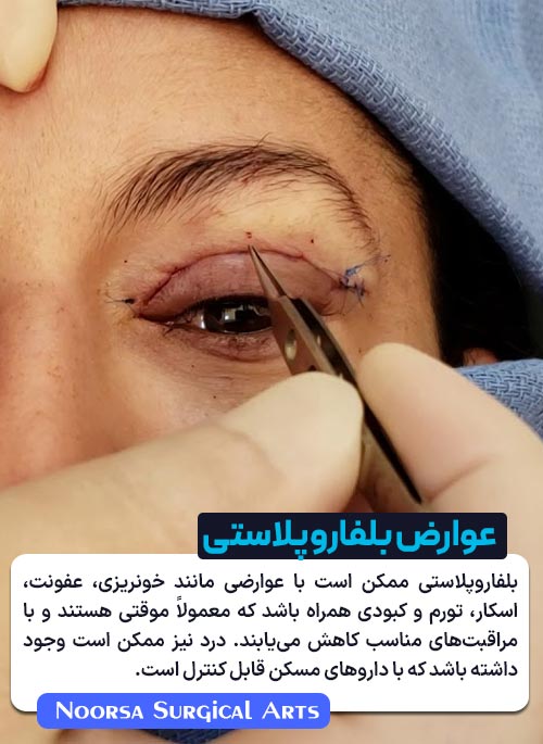 عوارض بلفاروپلاستی