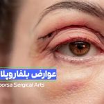 عوارض بلفاروپلاستی