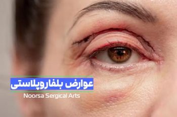 عوارض بلفاروپلاستی