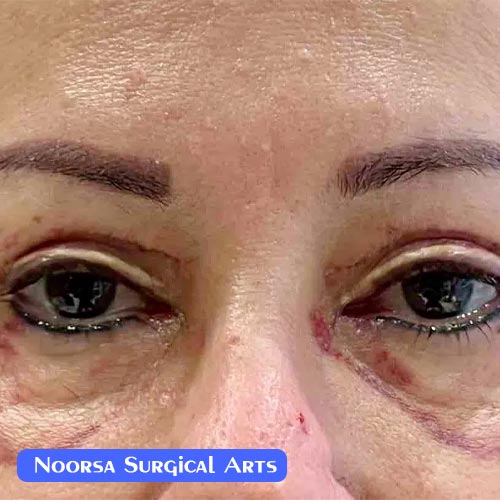 عوارض شدید جراحی پلک