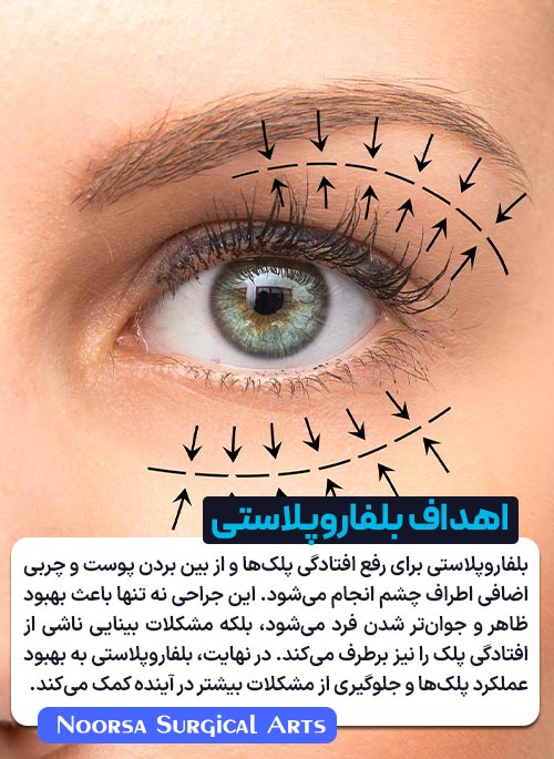 اهداف بلفاروپلاستی