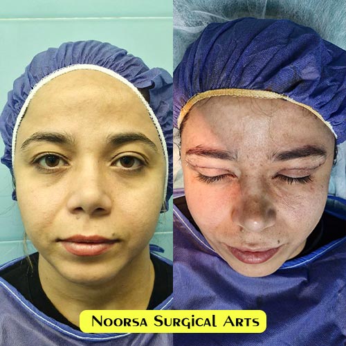 بلفاروپلاستی در کلینیک زیبایی نورسا
