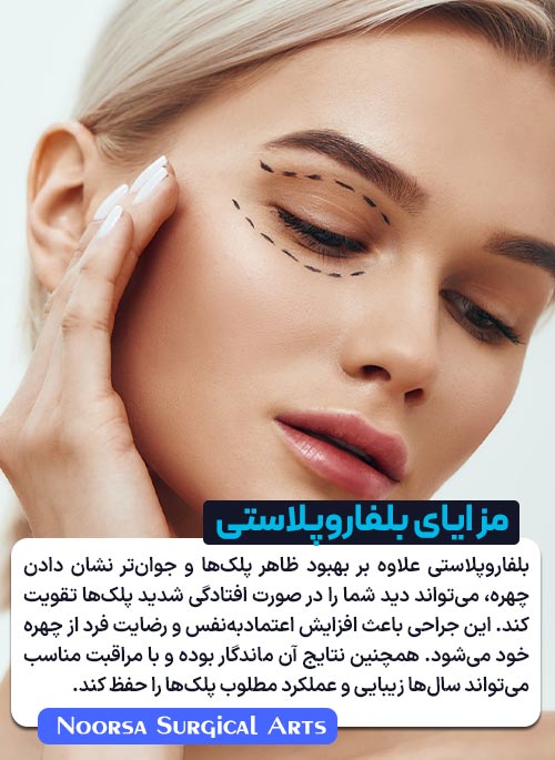 مزایای بلفاروپلاستی