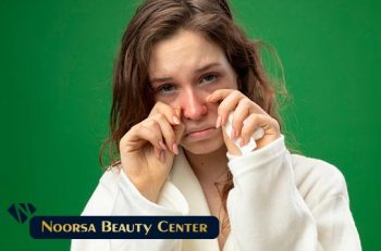 مدیریت استرس بعد از جراحی بینی
