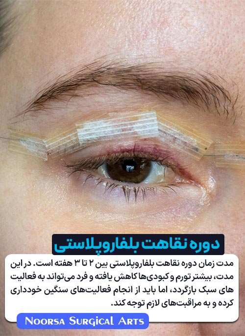 مدت زمان دوره نقاهت بلفاروپلاستی