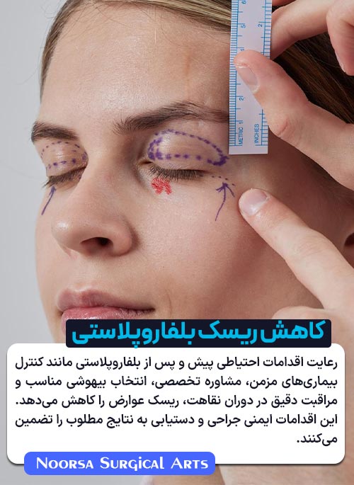 کاهش ریسک بلفاروپلاستی
