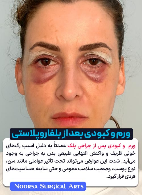 ورم و کبودی بعد از بلفاروپلاستی