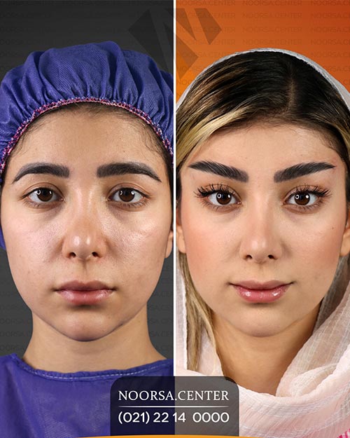 قبل و بعد از لیفت شقیقه در کلینیک نورسا 