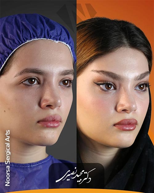 نمونه جراحی لیفت شقیقه با اندوتاین در کلینیک زیبایی نورسا