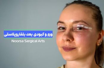 ورم و کبودی بعد از بلفاروپلاستی