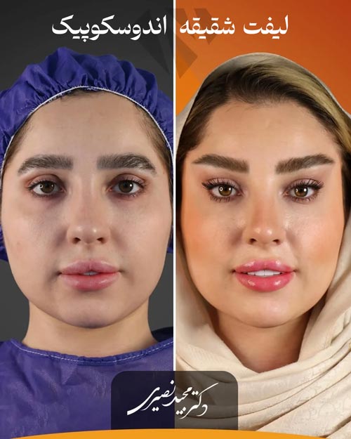 نتیجه جراحی لیفت شقیقه اندوسکوپیک 