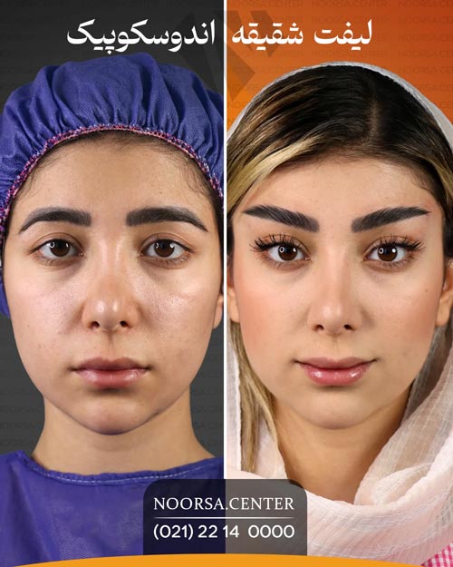 قبل و بعد از جراحی لیفت شقیقه اندوسکوپیک