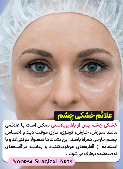 علائم خشکی چشم بعد از بلفاروپلاستی