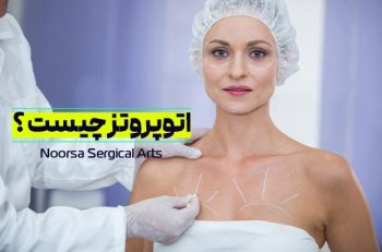 اتوپروتز سینه