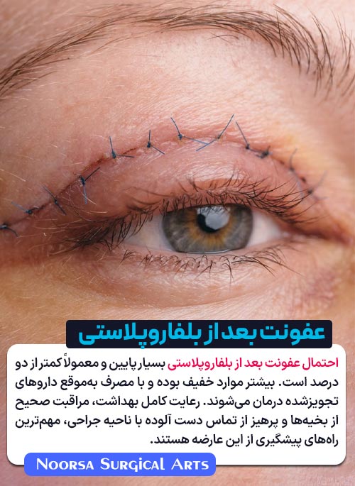 احتمال عفونت پس از عمل جراحی پلک