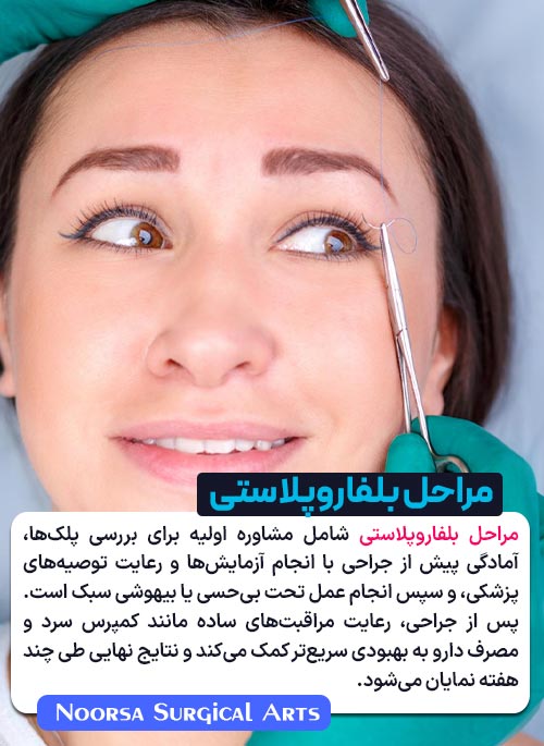 مراحل بلفاروپلاستی