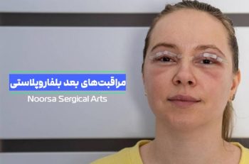 مراقبت های بعد از بلفاروپلاستی