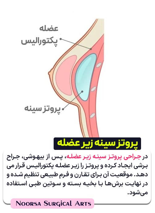 مراحل جراحی پروتز سینه زیر عضله