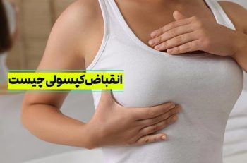 انقباض کپسولی چسیت