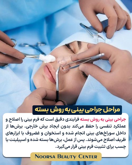مراحل جراحی بینی به روش بسته
