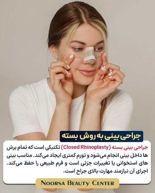 جراحی بینی به روش بسته