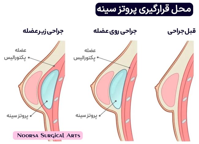 تفاوت جراحی روی عضله با جراحی زیر عضله در پروتز سینه