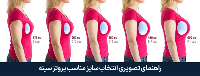 راهنمای تصویری انتخاب سایز پروتز سینه