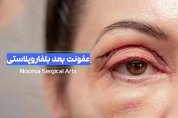 عفونت بعد از بلفاروپلاستی