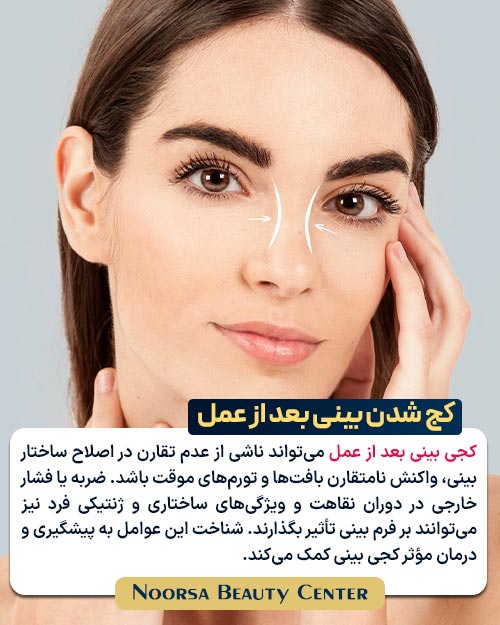 علت کج شدن بینی بعد از عمل