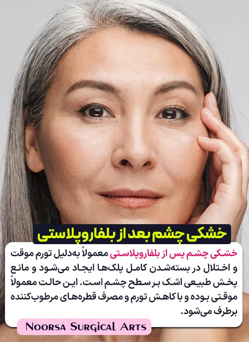 خشکی چشم بعد از بلفاروپلاستی