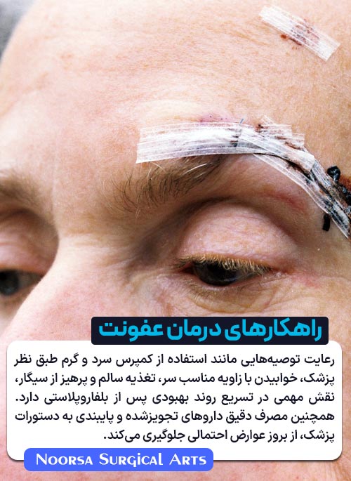 راهکارهای درمان عفونت بعد از جراحی پلک