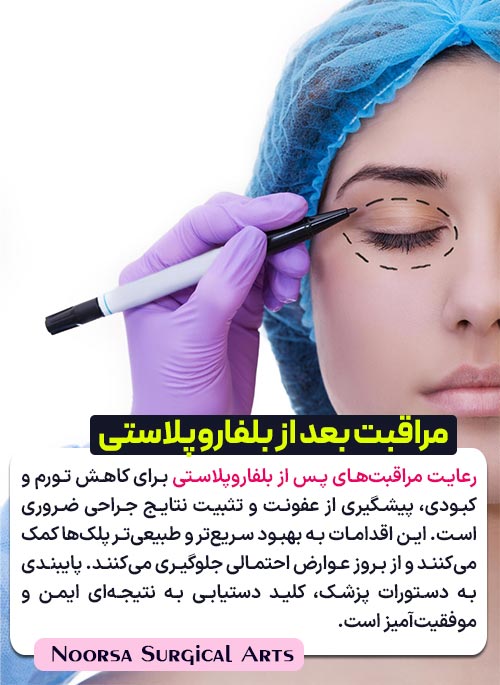مراقبت های بعد از بلفاروپلاستی