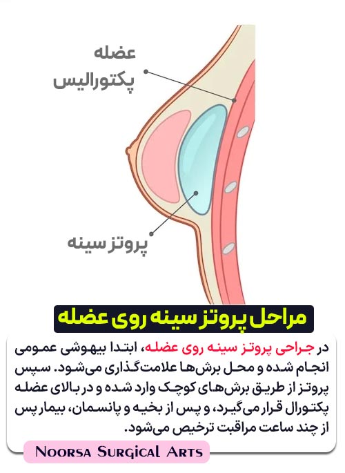مراحل جراحی پروتز سینه روی عضله