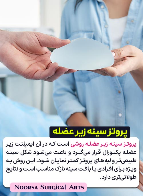 پروتز سینه زیر عضله