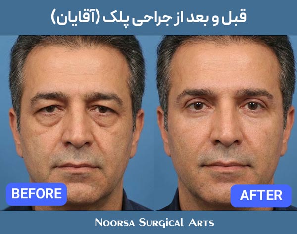 قبل و بعد از جراحی پلک آقایان