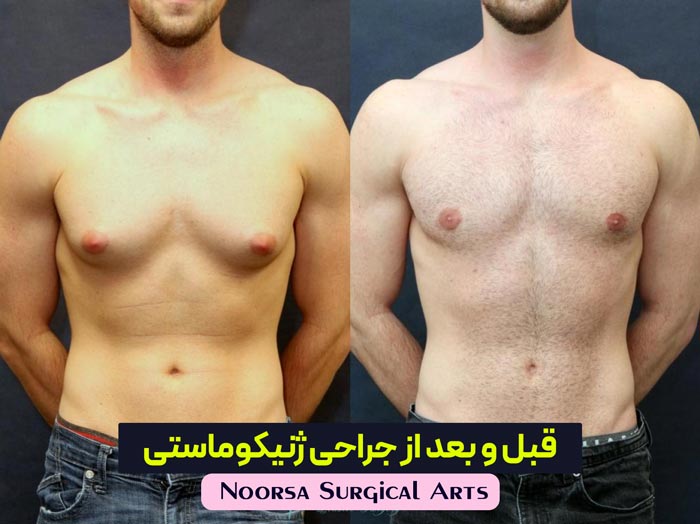 قبل و بعد از جراحی ژنیکوماستی