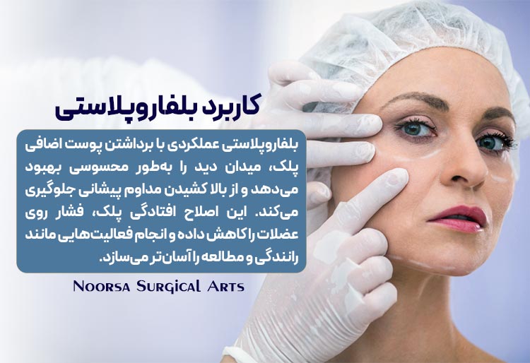 کاربرد بلفاروپلاستی