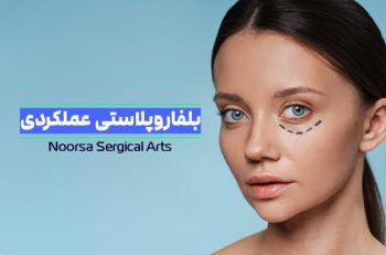 تاثیر بلفاروپلاستی بر بینایی