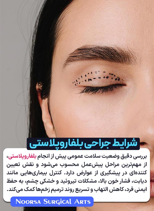 شرایط جراحی بلفاروپلاستی