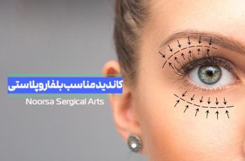 کاندید مناسب بلفاروپلاستی