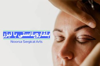 بلفاروپلاستی با لیزر