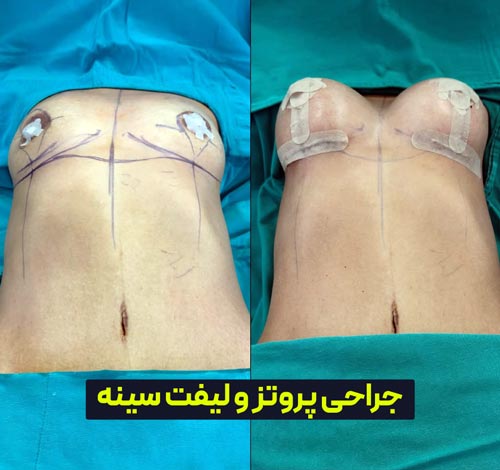 قبل و بعد از جراحی ماستوپکسی