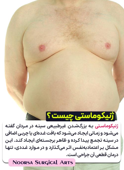 تعریف بیماری ژنیکوماستی