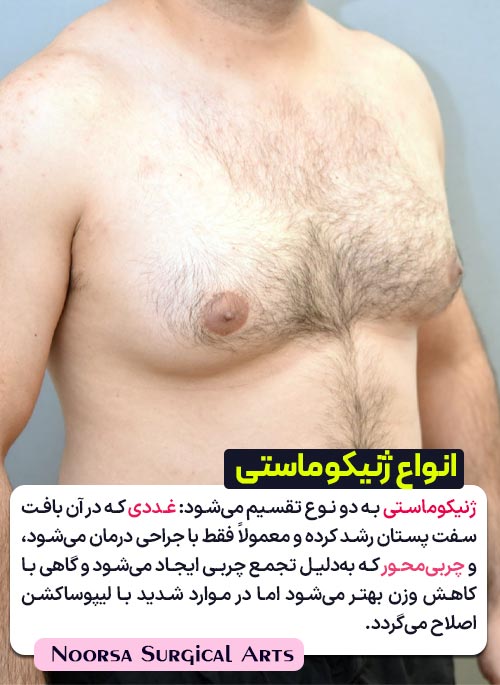 انواع ژنیکوماستی