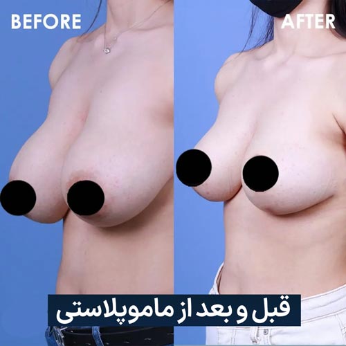 قبل و بعد از ماموپلاستی