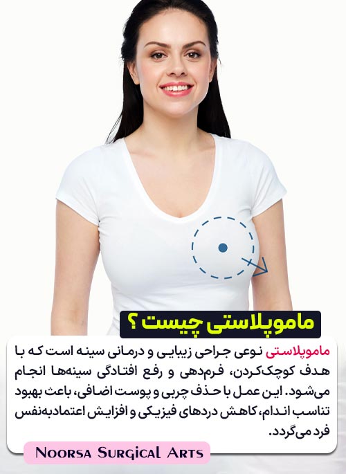 ماموپلاستی چیست