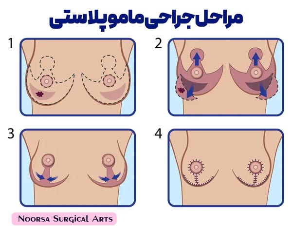 مراحل جراحی ماموپلاستی
